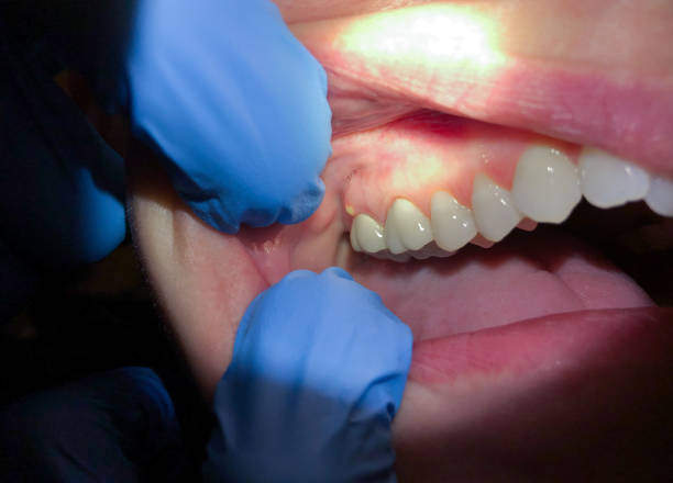 Best Emergency Root Canal Treatment in Woonsocket, RI