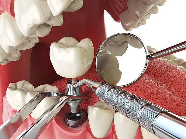 Best Emergency Dental Care for Broken or Chipped Teeth in Woonsocket, RI